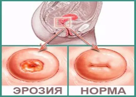 Fotografii de eroziune de col uterin (18 poze) (foto eroziunea colului uterin arata bolii) Fotografii de eroziune de col uterin (18 poze)