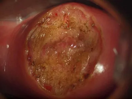 Fotografii de eroziune de col uterin (18 poze) (foto eroziunea colului uterin arata bolii) Fotografii de eroziune de col uterin (18 poze)