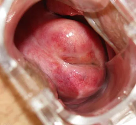 Fotografii de eroziune de col uterin (18 poze) (fotografii) Fotografii de eroziune de col uterin (18 poze)