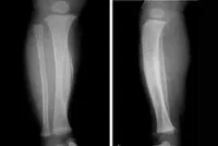 Hiperostoză - cauze, simptome, diagnostic și tratament