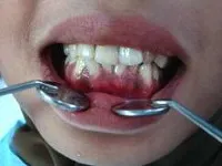 Gingivita la copii - cauze, simptome, diagnostic și tratament (pentru copii) Gingivita la copii - cauze, simptome, diagnostic și tratament