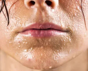 Hiperhidroza Face cauze si tratament