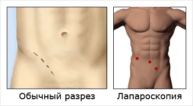 Hernie herniei operație