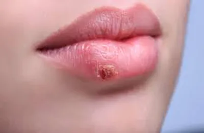 Herpes in timpul sarcinii este periculoasă decât efectul și consecințele (sarcina) Herpes in timpul sarcinii este periculoasă decât efectul și consecințele