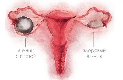 cauze cervicale hipertrofia și tratament ca remedii populare (hipertrofia) aruncare Cauzele hipertrofia cervicale și tratament, cum să scape de remedii populare