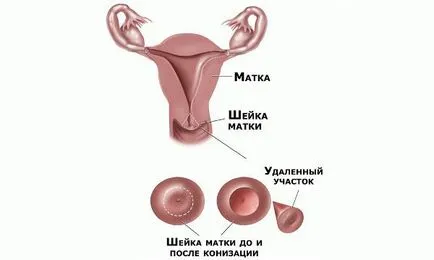 hipertrofia de col uterin