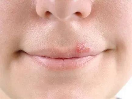 Herpes simptomelor copiilor si tratamentul virusului in organismul copilului