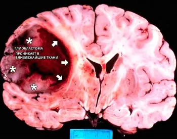 Brain Glioblastoma, simptomatologie și gradul de umflare, opțiuni de tratament (creier) Brain glioblastom, simptomatologia și gradul de umflare, optiuni de tratament pentru
