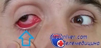 infecții oculare