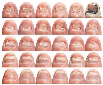 Mucegaiuri pe degetele picioarelor foto, simptome, cauze, tratament, prevenire (ciuperci) Ciupercii degete Foto picioare, simptome, cauze, tratament, prevenirea
