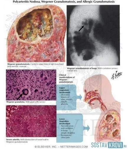 granulomatoza Wegener cauze, simptome, diagnostic, tratament și prognostic