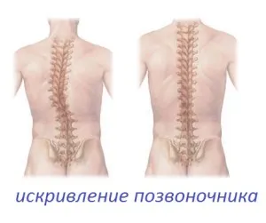 curbură a coloanei vertebrale - cum de a vindeca simptomele, Chiropractic (curbura) curbură a coloanei vertebrale - cum de a vindeca simptomele, Chiropractic