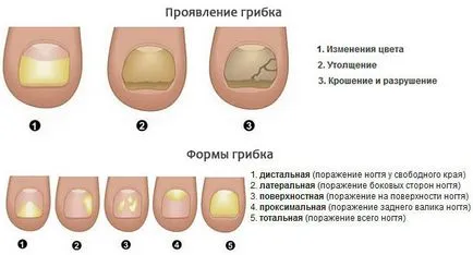 comentarii Irunine, instrucțiuni de utilizare cu ciuperca unghiilor, contraindicatii, pret