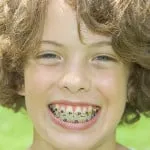 corecție Bite în fotografie a copilului înainte și după (după) Bite de corecție în fotografie a copilului înainte și după