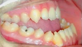 Malocluzie chirurgical - inainte si dupa fotografii, preturi, comentarii (corecție) Malocluzie chirurgical - inainte si dupa fotografii, preturi, comentarii