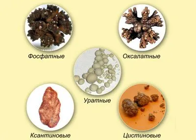 Excesul de sare in simptome ale corpului metodele de eliminare