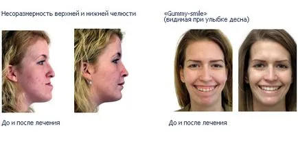 Malocluzie chirurgical - etapele (mușcătura) Malocluzie chirurgical - etapele