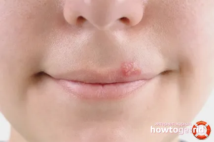 Cât de repede vindeca herpes labial