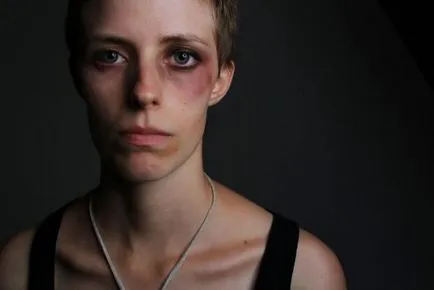 Cum să eliminați rapid un ochi negru (ochi) Cum să eliminați rapid un ochi negru