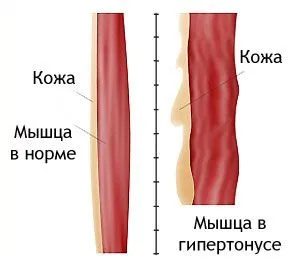 tonus muscular crescut în copil