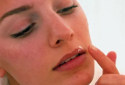 Cum și ce să trateze herpes la copii