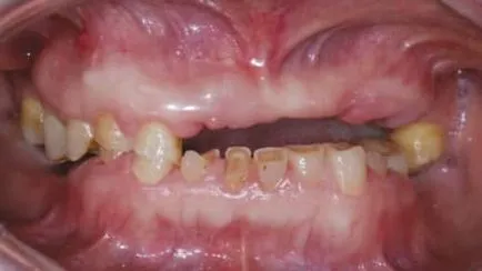 Cum sa scapi si vindecarea cariilor dentare