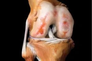 Cum de a trata osteoartrita genunchiului în tratamentul acasă de o varietate de moduri