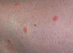 Cum de a trata muscaturile de furnici in casa, cum să se trateze la domiciliu (condiții) Cum de a trata la domiciliu musca furnicile, cum să se trateze la domiciliu