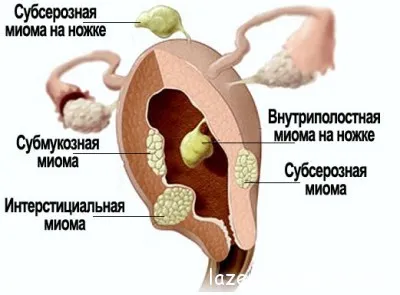 Cum de a trata fibrom uterin, cauzele, prevenirea