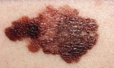 Cum de a trata melanomul