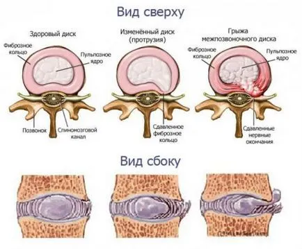 Cum de a trata disc protruzia de gimnastica a coloanei vertebrale lombare (video) (tratate) Cum de a trata disc protruzia de gimnastica a coloanei vertebrale lombare (video)
