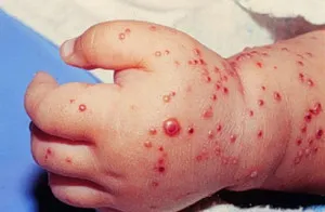 Cum tratamentul Staphylococcus aureus