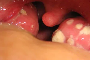 Cum tratamentul Staphylococcus aureus