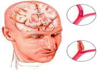Cauzele de accident vascular cerebral - ca apare din ceea ce se întâmplă la femei, bărbați, tineri