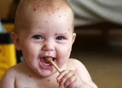 Cosurile de pe fata la sugari 1 (coșuri) Cosurile de pe fata la sugari 1