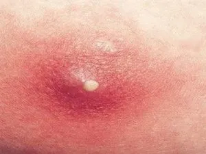 Cauzele pustule pe fata si tratamentul acestora