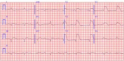 Semne de infarct miocardic (inclusiv severe)