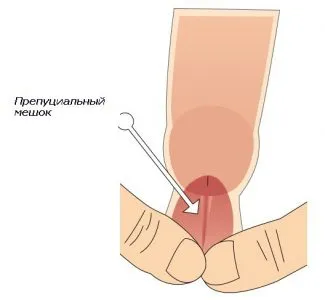 Cum sa se intinda prepuțul când este complet deschis la domiciliu (complet) Cum sa se intinda preput atunci când este complet deschis la domiciliu