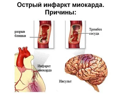 Cum de a recunoaște un infarct miocardic pe ECG - parametrii de decodare (atac de cord) Cum de a recunoaște un infarct miocardic pe ECG - performanta decodare