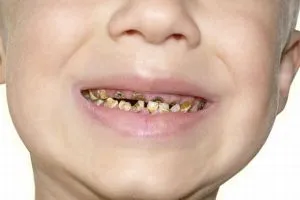 Cum de a salva dintii putred de ce au putregai, consecințele pentru organism, ce să facă (de ce dintii putrezesc din interior) Cum de a salva dintii putred de ce au putregai, consecințele pentru organism, ce să facă