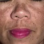 Cum de a elimina petele intunecate pe fata la domiciliu, în cabină, video, crema reală,