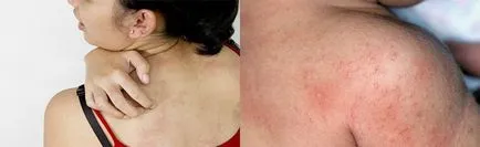 cauze psoriazis si tratament