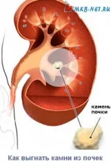 Cum de a expulza pietre la rinichi - experiența mea personală (experienta) Cum de a expulza pietre la rinichi - experiența mea personală
