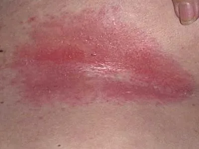 Cum de a vindeca de căldură înțepător în casă (sudamen) Cum de a vindeca de căldură înțepător în casă