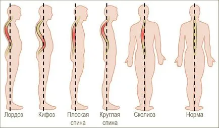 Cum să îndreptați coloanei vertebrale în acasă (acasă) Cum să îndreptați coloanei vertebrale în casă