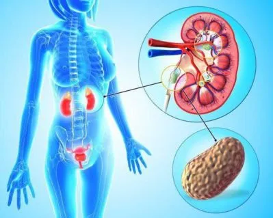 O piatră în ureter cum să aducă bărbați și femei, simptome și tratament