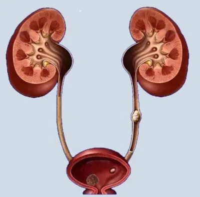 O piatră în ureter cum să aducă bărbați și femei, simptome și tratament