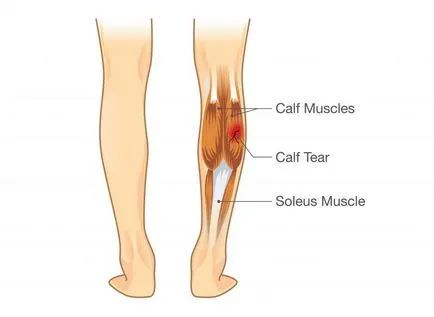 Ruperea simptome musculare și de prim ajutor