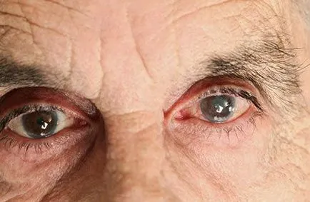 ochi cataractă