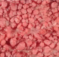 Chistul simptome de stomac, cauze, diagnostic, tratament